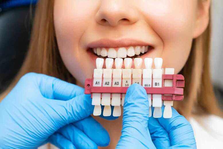 Wie viele Veneers benötigt man für ein vollständiges Set?
